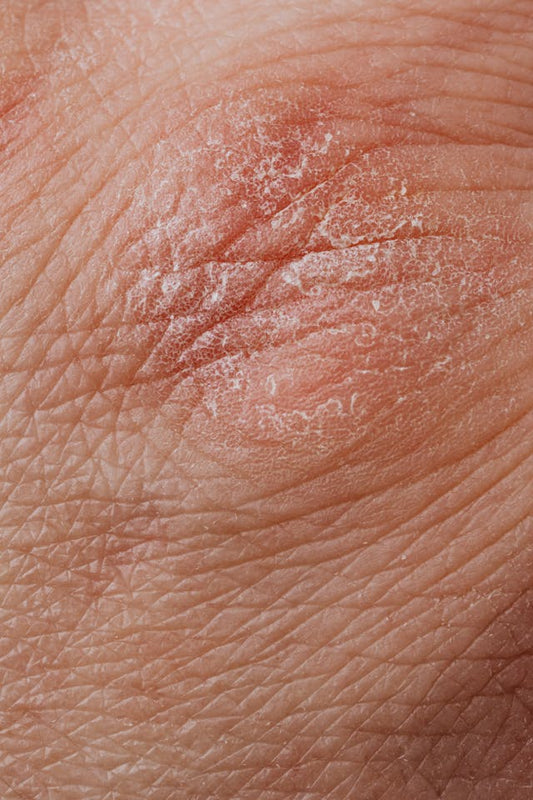 Why Gardeners Get Chapped Hands (And How to Actually Fix It)